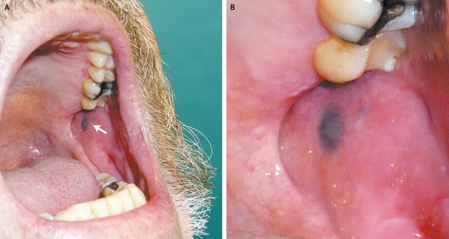 Shows amalgam tattoo as blue-gray lesion on alveolar mucosa. (For... |  Download Scientific Diagram
